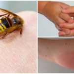 Reacția alergică la vânatul de viespi